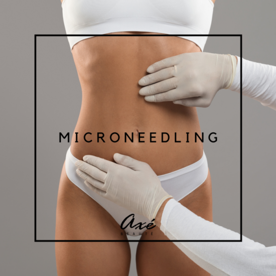 Microneedling grande zone corps Microneedling grande zone corps